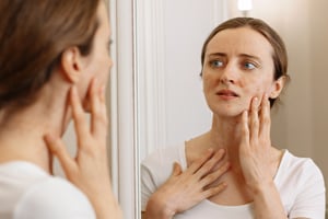 Acne, eczema e dermatiti: Il ruolo dell’agopuntura per la pelle
